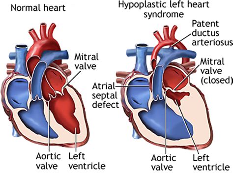 lv hypoplasia|hypoplastic left heart prognosis.